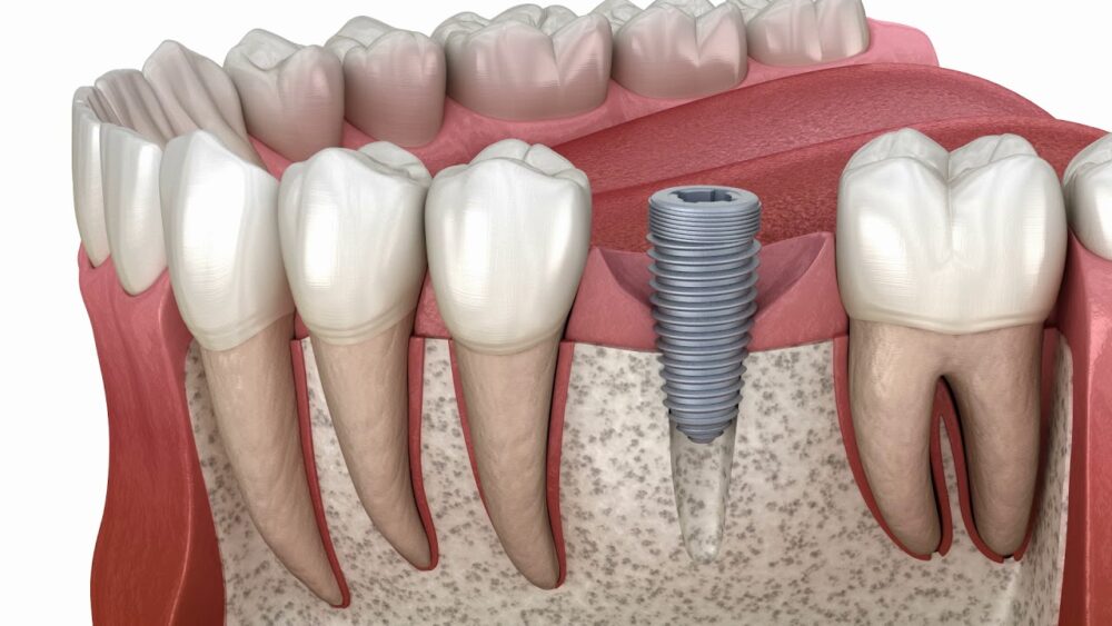 Γιατί χρειάζεστε ένα οδοντικό εμφύτευμα και ποιοι είναι οι τύποι του;