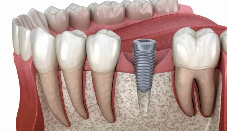 Γιατί χρειάζεστε ένα οδοντικό εμφύτευμα και ποιοι είναι οι τύποι του;